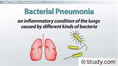 Bacterial Pneumonia: Causes, Signs & Treatments - Lesson | Study.com