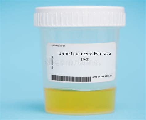 Urine Leukocyte Esterase Test Stock Photo - Image of cells, blood ...