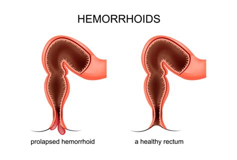 Hemorrhoids: Definition, Types, Causes, And Symptoms - Fresh Online News