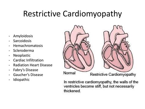 PPT - Cardiomyopathies PowerPoint Presentation, free download - ID:1914272