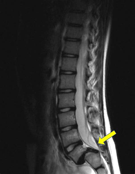 Cureus | Scoliosis Associated with Lumbar Spondylolisthesis: Spontaneous Resolution and Seven ...