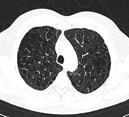 COPD : 네이버 블로그