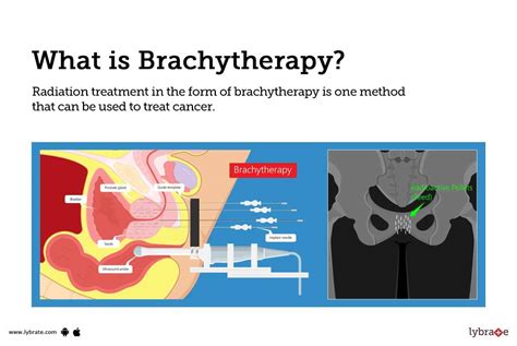 Internal Radiation Brachytherapy