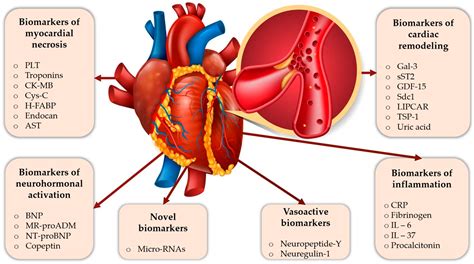 Myocardial Infarction Symptoms