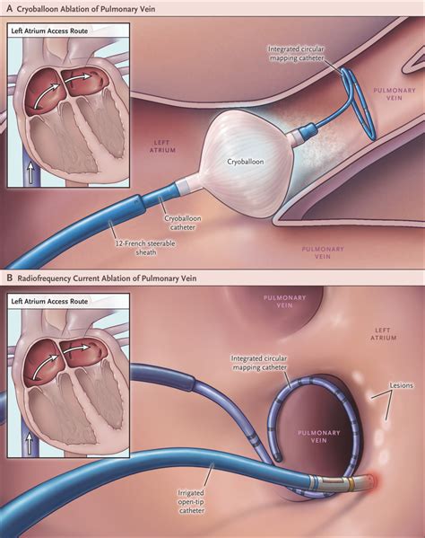 Cryoballoon or Radiofrequency Ablation for Paroxysmal Atrial ...