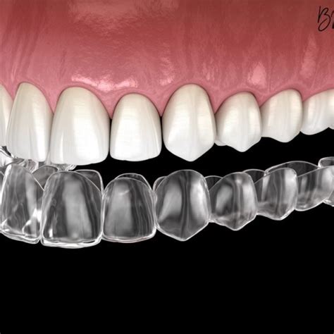 Essix Retainer Upper – Lower – BM Ortho Appliances Inc.