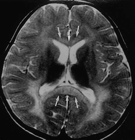 Leukodystrophy in Children: A Pictorial Review of MR Imaging Features | RadioGraphics