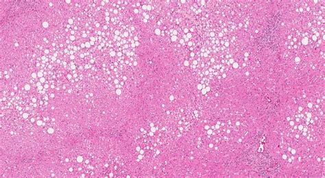 Steatosis | Atlas of Pathology