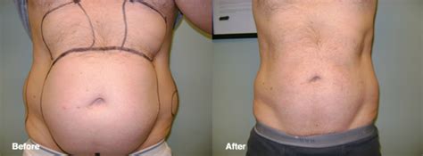 Lipo Photo Gallery | Smart Lipo Cleveland