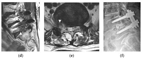 JCM | Free Full-Text | The Novel Technique of Uniportal Endoscopic Interlaminar Contralateral ...