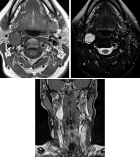 Carotid Body Glomus Tumor (Glomus Caroticum; Carotid Body Paraganglioma) | The Neurosurgical Atlas