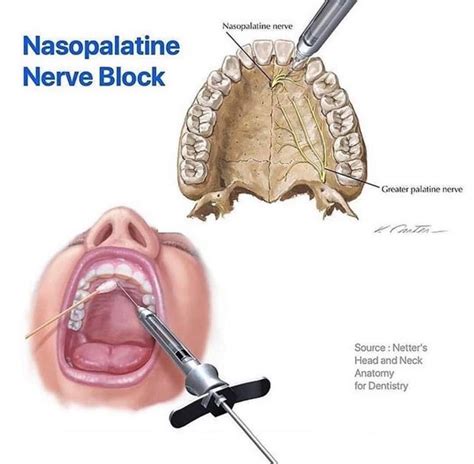 simpatía el primero demandante nasopalatine nerve block Gruñido A rayas Principiante