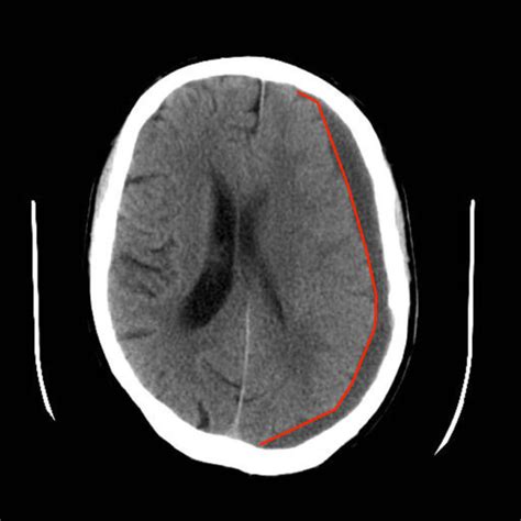 Subdural Haemorrhage | Intracranial Haemorrhage | Geeky Medics