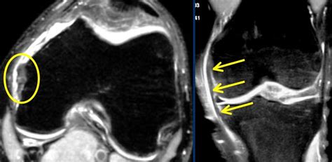 The Radiology Assistant : Knee - Non-Meniscal pathology