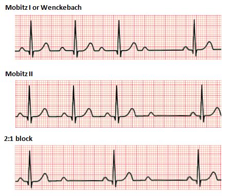 Difference Between 1st 2nd and 3rd Degree Heart Block | Compare the ...