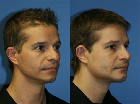 Jaw Contouring New York City | Gotham Plastic Surgery