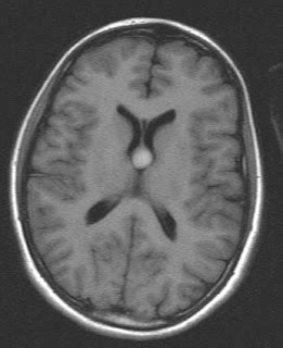 Colloid Cyst-MRI - Sumer's Radiology Blog