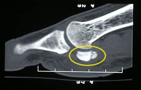 Sesamoid Thumb