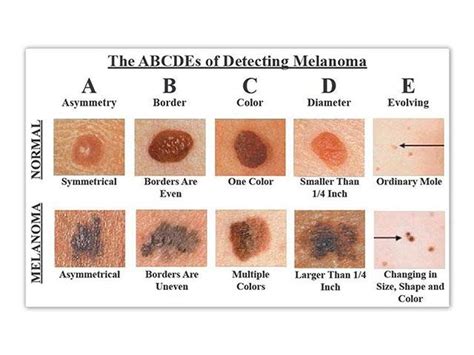 E (Evolving) change in the size, shape, or color of a mole or the ...