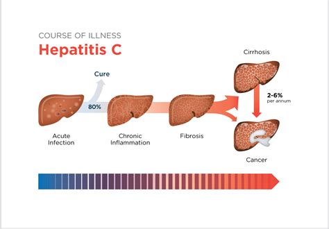 Hepatitis C | Premier Medical, Inc