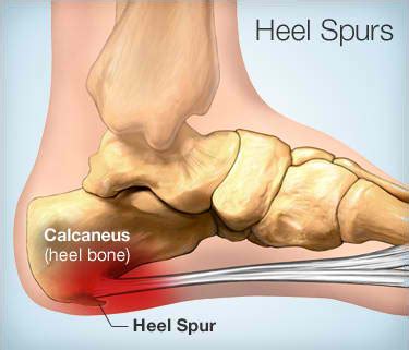 Heel Pain: Heel Spur Symptoms and Treatment