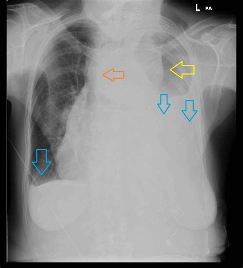 Aortic Dissection On Chest X Ray