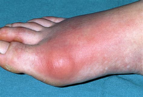 Suffering from Gout attacks? | 🩺Singapore Sports & Orthopaedic Surgeon