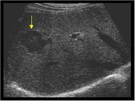 Atypical hemangioma | Abdomen, Liver, Ultrasound