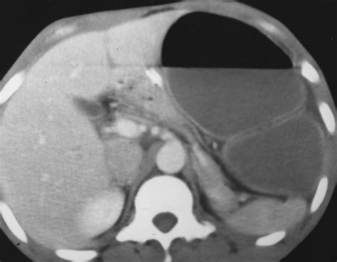 CT of Cecal Volvulus Unraveling the Image | AJR