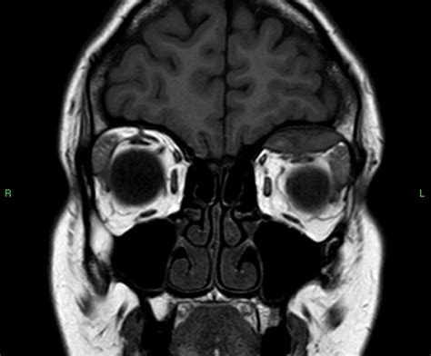 Subperiosteal Orbital Hematoma- Clinical Advisor