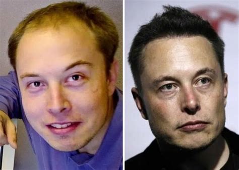 Elon Musk Before and After Plastic Surgery: Hair transplant