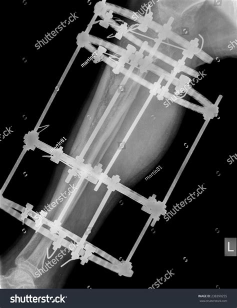 Broken Tibia Fibula Xray Stock Photo 238390255 | Shutterstock