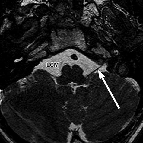 4th Cranial Nerve Mri