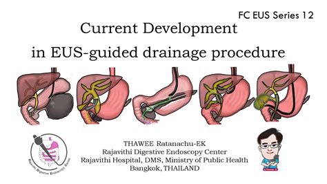 EUS drainage Procedure current development - YouTube