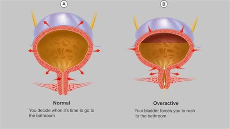 The Dos and Don’ts for Managing an Overactive Bladder Through Diet | Everyday Health