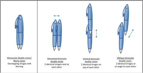 Common Eye Symptoms - Double Vision