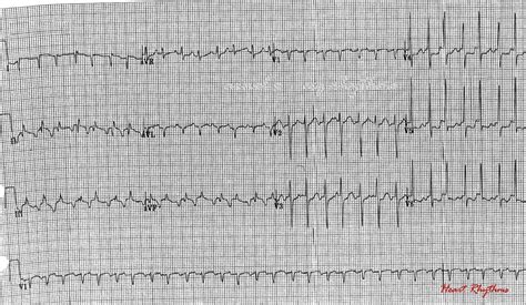 ECG Rhythms: A long RP tachycardia with alternating cycle length