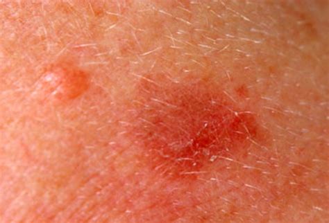 👉 Actinic Keratosis - Pictures, Causes and Treatment (December 2021)