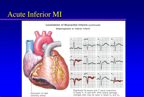 Inferior Wall Myocardial Infarction Treatment - vrogue.co