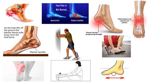 Plantar Fasciitis Definition | Examples and Forms