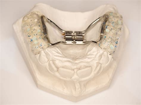 4 Types of Palate Expanders (Uses, Side Effects & FAQs)