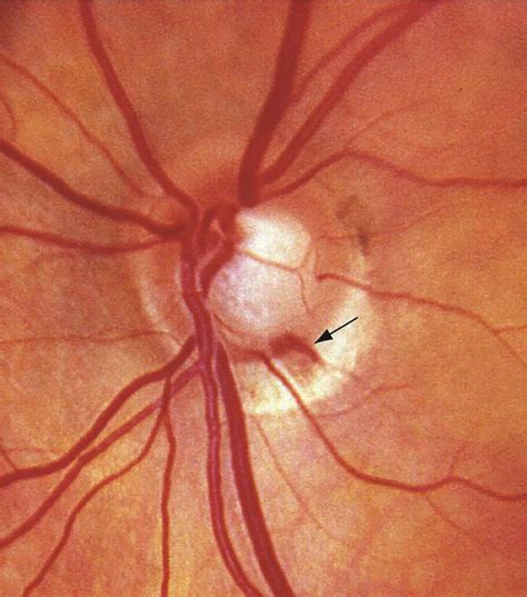 Flame-shaped hemorrhage - American Academy of Ophthalmology