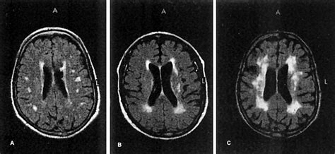 Leukoaraiosis | Stroke