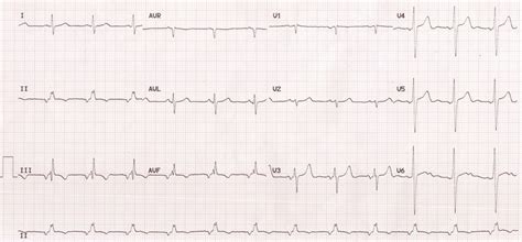 Low atrial rhythm – ECG – All About Cardiovascular System and Disorders