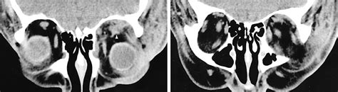 Necrotizing Fasciitis of the Eyelids and Orbit | JAMA Ophthalmology | The JAMA Network