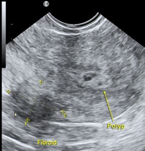 Chapter 6 – Endometrial polyps – Melaka Fertility