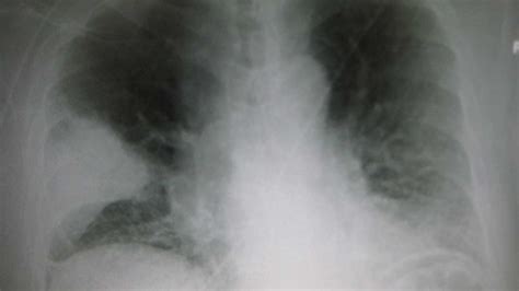 Lung Consolidation: Treatment, vs Pleural Effusion, and More