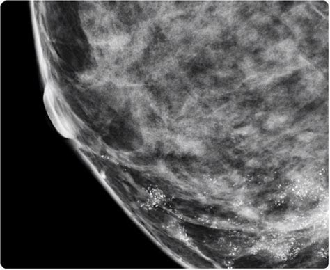 Microcalcifications in Breast Cancer