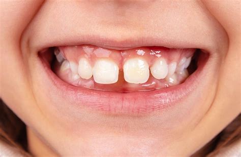 Treatment Options For Fixing a Gap Between Teeth : Tompkins Dental ...