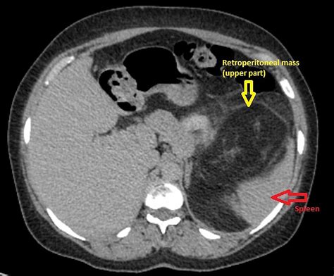 Cureus | En Bloc Resection of a Giant Retroperitoneal Liposarcoma: A ...